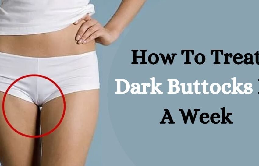 How To Treat Dark Buttocks In A Week