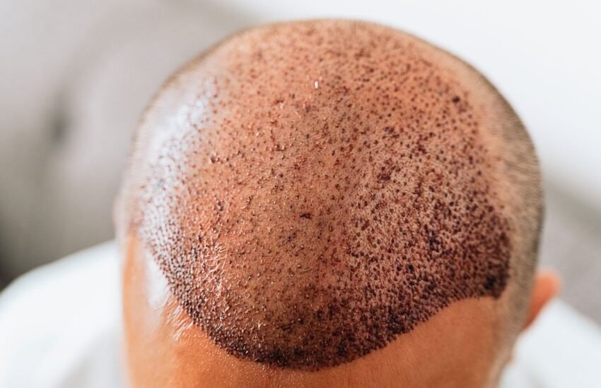 Post Hair Transplant Care: The First Wash and Drying Process